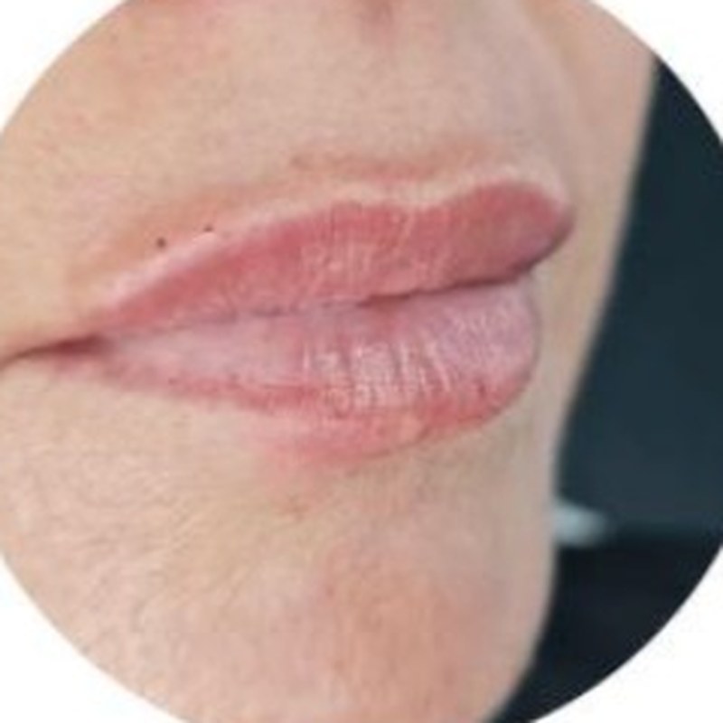 Labios hialurónico Málaga
