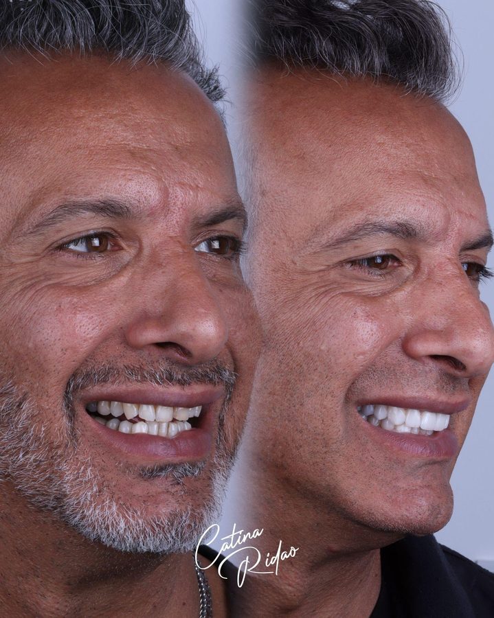Diseño de sonrisa DSD Málaga