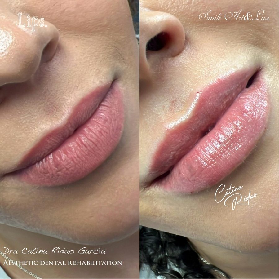 Labios hialurónico Málaga