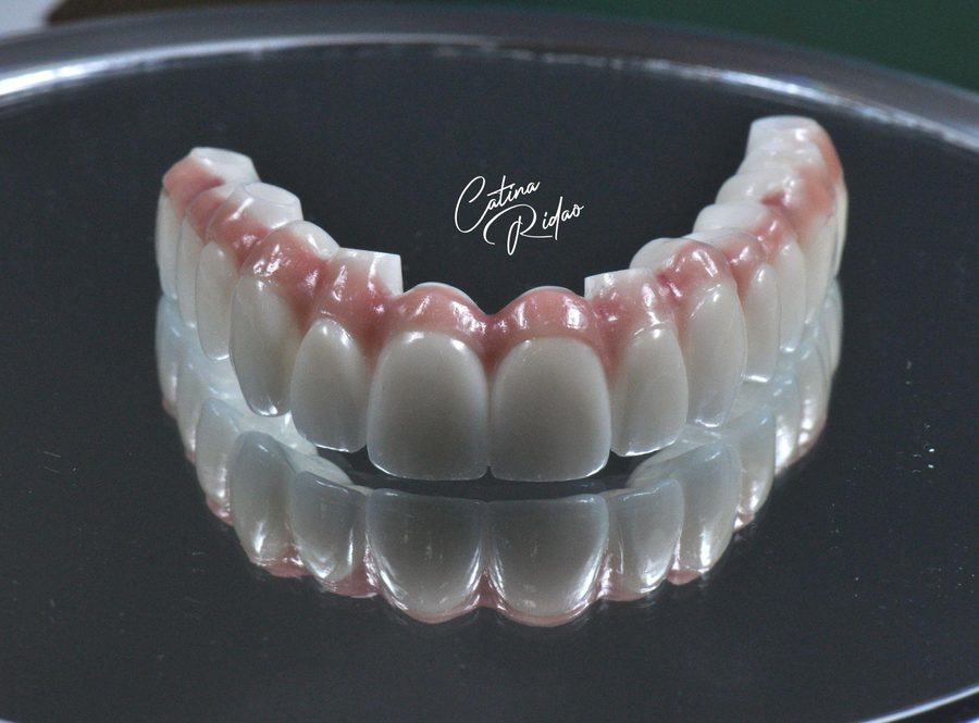 Rehabilitación oral implantes Málaga