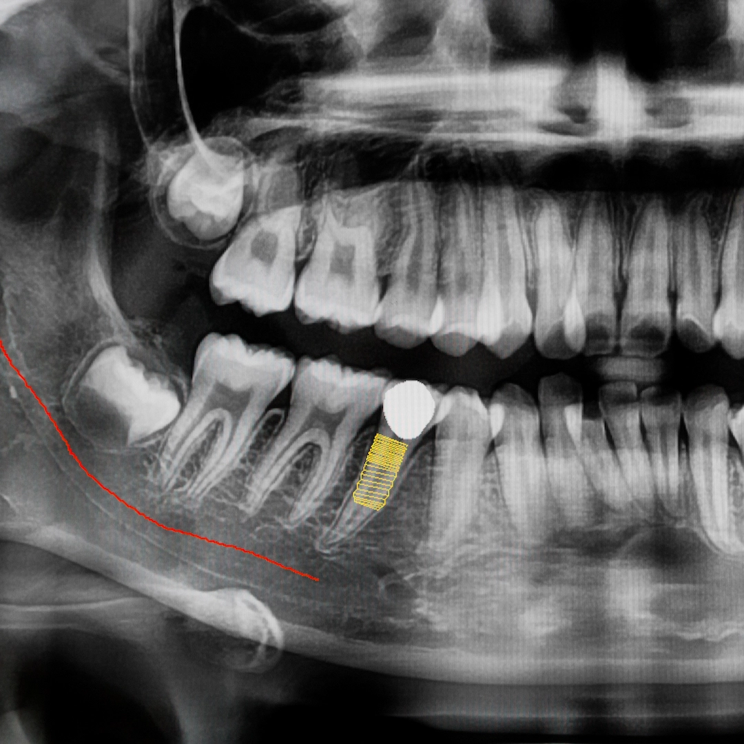 tinywow_digital-x-ray-of-jaw-with-implant-tooth-2021-08-30-18-50-07-utc (2)_17168983 (2)