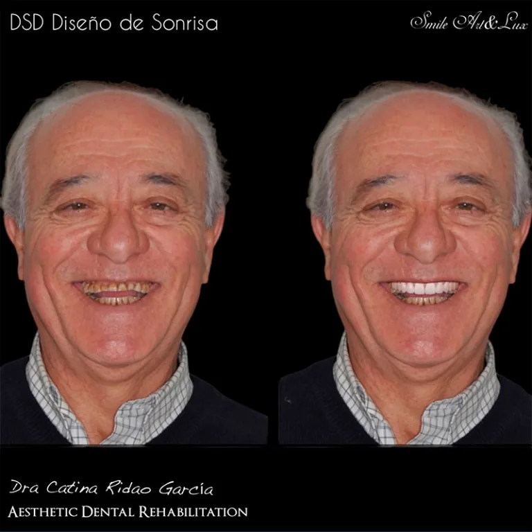 Diseño de sonrisa